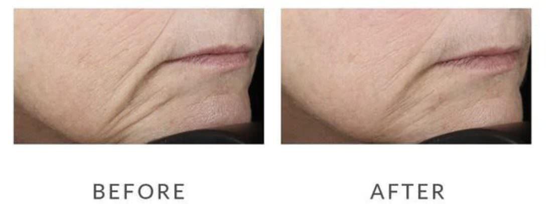 NuFACE Mini 臉部緊緻美容儀（NuFACE Mini Facial Toner-使用前後對比